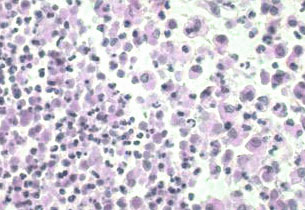 Inflammation banale Inflammation banale