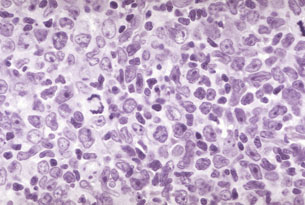 Lymphome Lymphome